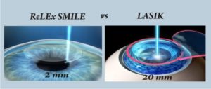 Kappadokien ReLex Smile in Istanbul und Antalya