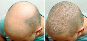 Vorher- Nachher Haartransplantation in Izmir